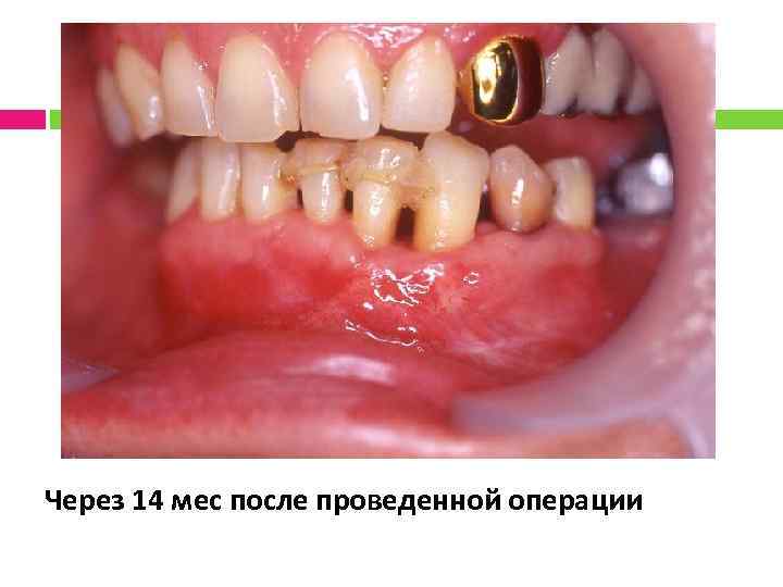 Через 14 мес после проведенной операции 