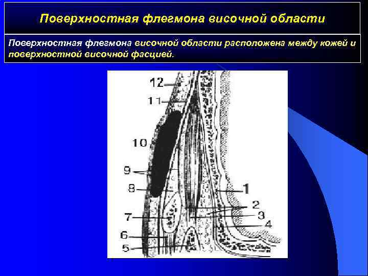 Поверхностная флегмона височной области расположена между кожей и поверхностной височной фасцией. 