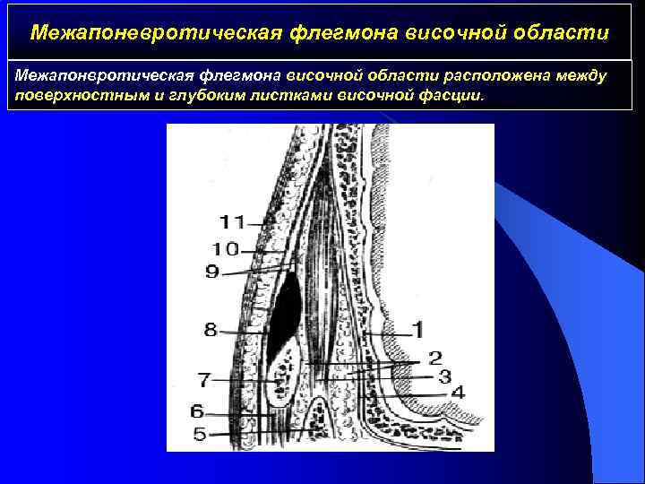 Межапоневротическая флегмона височной области Межапонвротическая флегмона височной области расположена между поверхностным и глубоким листками