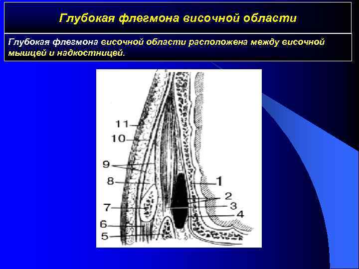 Глубокая флегмона височной области расположена между височной мышцей и надкостницей. 