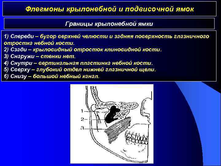 Крылонебная ямка сообщается. Флегмона подвисочной области границы. Абсцесс крылонебной ямки. Флегмона крыловидно небной ямки. Абсцесс и флегмона крылонебной ямки.