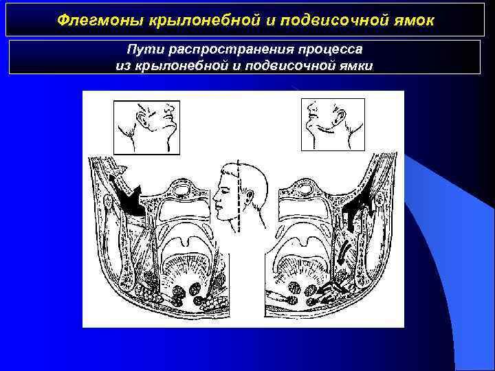 Границы флегмоны