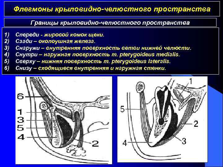 Флегмоны крыловидно-челюстного пространства Границы крыловидно-челюстного пространства 1) 2) 3) 4) 5) 6) Спереди -