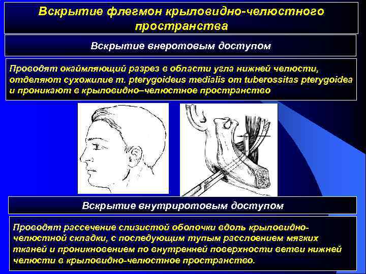 Вскрытие флегмон крыловидно-челюстного пространства Вскрытие внеротовым доступом Проводят окаймляющий разрез в области угла нижней