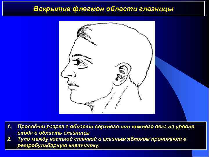 Вскрытие флегмон области глазницы 1. 2. Проводят разрез в области верхнего или нижнего века