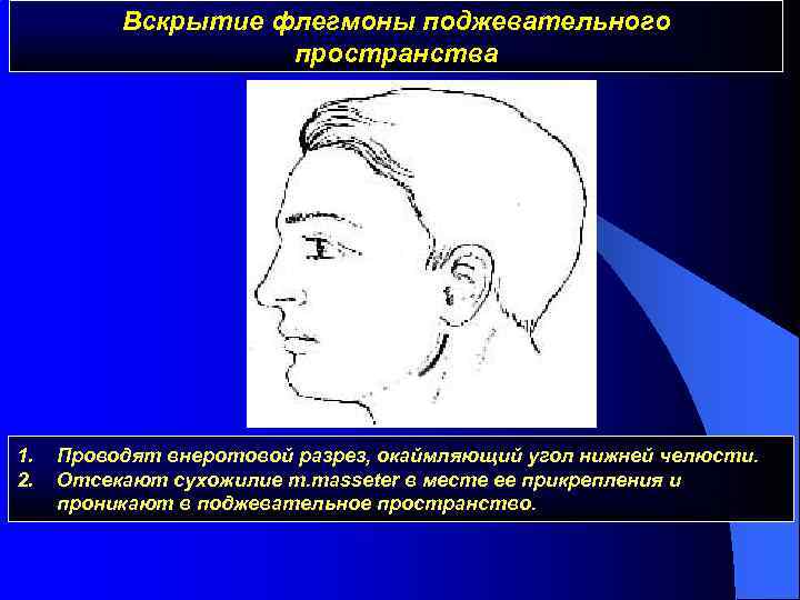 Вскрытие флегмоны поджевательного пространства 1. 2. Проводят внеротовой разрез, окаймляющий угол нижней челюсти. Отсекают