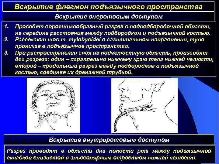 Вскрытие флегмон подъязычного пространства Вскрытие внеротовым доступом 1. 2. 3. Проводят воротникообразный разрез в