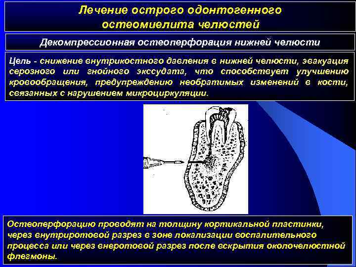 Лечение острого одонтогенного остеомиелита челюстей Декомпрессионная остеоперфорация нижней челюсти Цель - снижение внутрикостного давления