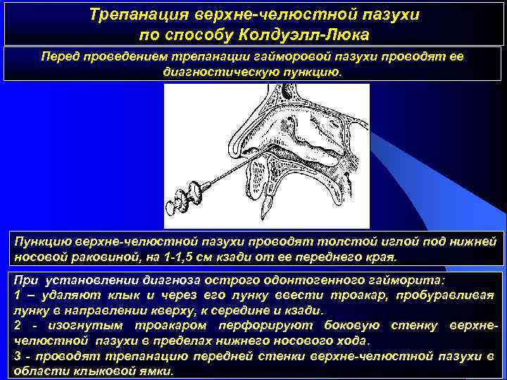 Трепанация верхне-челюстной пазухи по способу Колдуэлл-Люка Перед проведением трепанации гайморовой пазухи проводят ее диагностическую