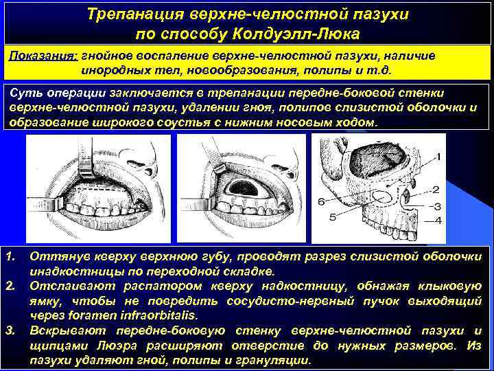 Трепанация верхне-челюстной пазухи по способу Колдуэлл-Люка Показания: гнойное воспаление верхне-челюстной пазухи, наличие инородных тел,