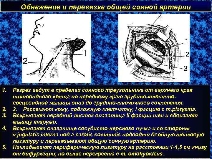 Обнажение и перевязка общей сонной артерии 1. 2. 3. 4. 5. Разрез ведут в