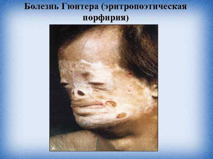 Болезнь Гюнтера (эритропоэтическая порфирия) 
