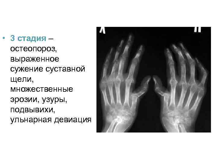  • 3 стадия – остеопороз, выраженное сужение суставной щели, множественные эрозии, узуры, подвывихи,