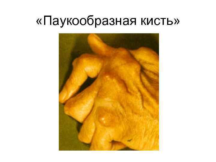  «Паукообразная кисть» 