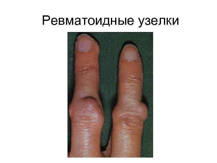 Ревматоидные узелки 