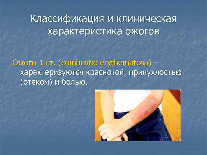 Классификация и клиническая характеристика ожогов Ожоги 1 ст. (combustio erythematosa) – характеризуются краснотой, припухлостью