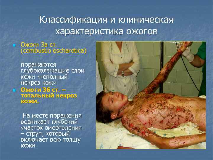 Классификация и клиническая характеристика ожогов n n Ожоги 3 а ст. (combustio escharotica) поражаются