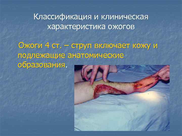 Классификация и клиническая характеристика ожогов Ожоги 4 ст. – струп включает кожу и подлежащие