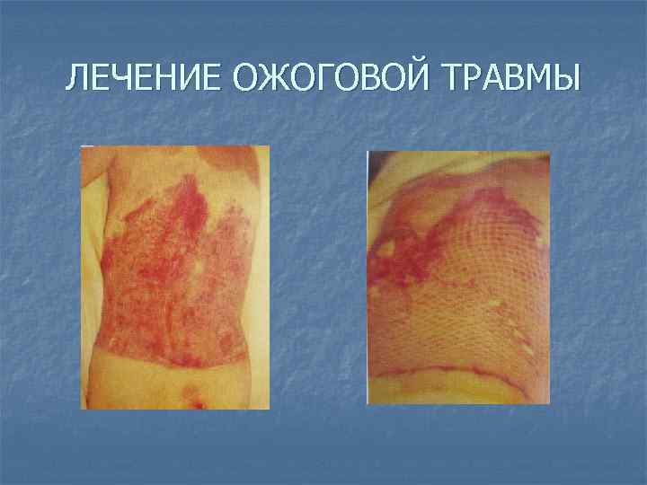 ЛЕЧЕНИЕ ОЖОГОВОЙ ТРАВМЫ 