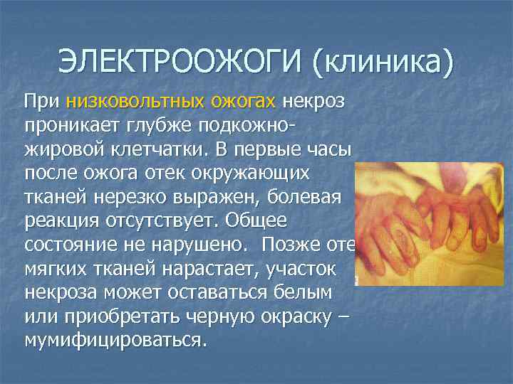 ЭЛЕКТРООЖОГИ (клиника) При низковольтных ожогах некроз проникает глубже подкожножировой клетчатки. В первые часы после