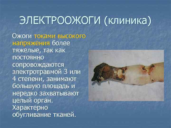 ЭЛЕКТРООЖОГИ (клиника) Ожоги токами высокого напряжения более тяжелые, так как постоянно сопровождаются электротравмой 3