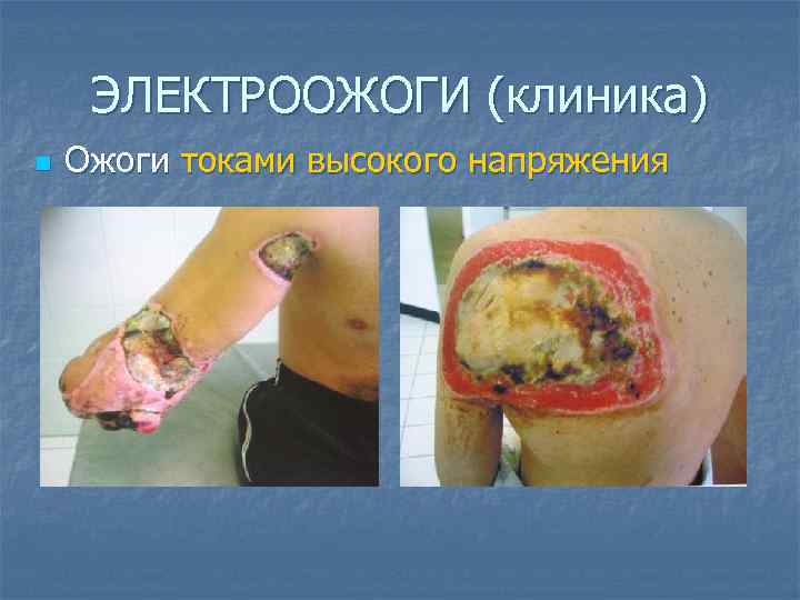 ЭЛЕКТРООЖОГИ (клиника) n Ожоги токами высокого напряжения 