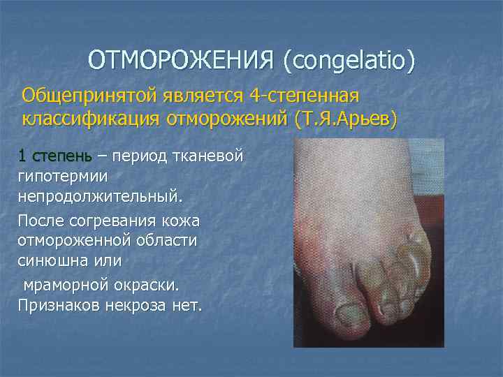 ОТМОРОЖЕНИЯ (congelatio) Общепринятой является 4 -степенная классификация отморожений (Т. Я. Арьев) 1 степень –