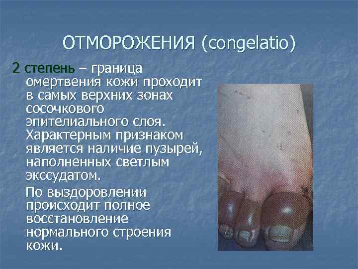 ОТМОРОЖЕНИЯ (congelatio) 2 степень – граница омертвения кожи проходит в самых верхних зонах сосочкового