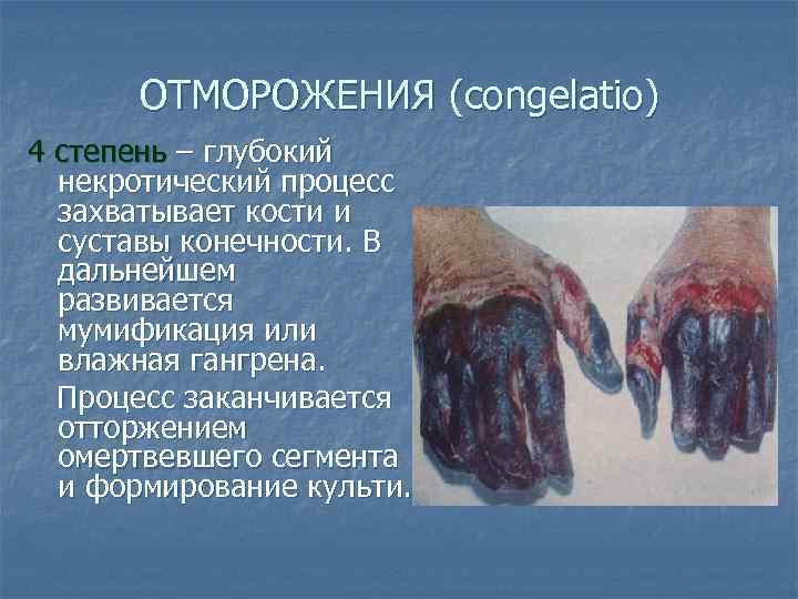 ОТМОРОЖЕНИЯ (congelatio) 4 степень – глубокий некротический процесс захватывает кости и суставы конечности. В