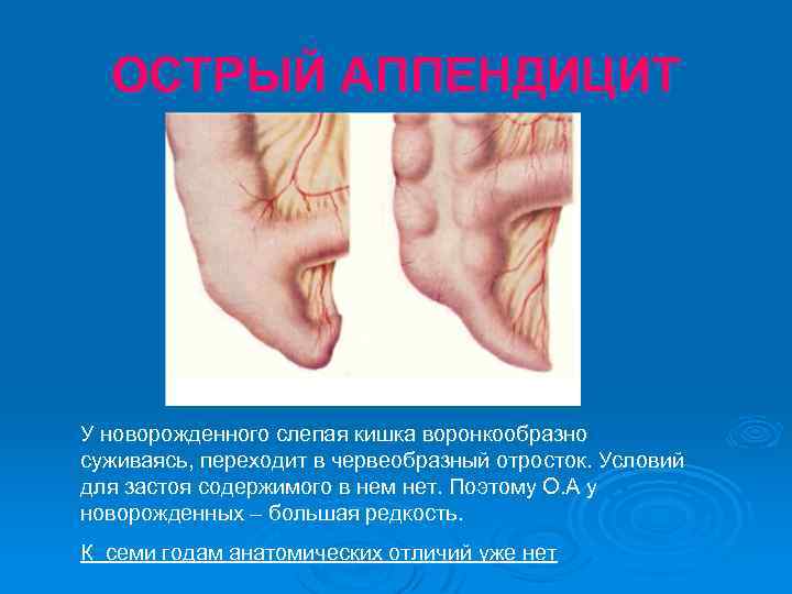 ОСТРЫЙ АППЕНДИЦИТ У новорожденного слепая кишка воронкообразно суживаясь, переходит в червеобразный отросток. Условий для