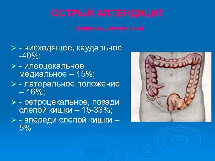 ОСТРЫЙ АППЕНДИЦИТ (клиника, диагностика) - нисходящее, каудальное -40%; Ø - илеоцекальное медиальное – 15%;