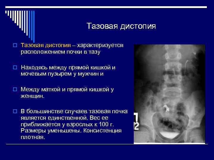 Дистопия почки. Тазовая дистопия почки рентген. Поясничная дистопия левой почки рентген. Дистопия почки рентген признаки.