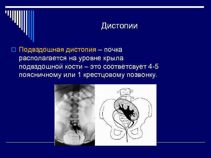 Дистопия почки. Пояснично-подвздошная дистопия почки. Торакальная дистопия почки. Тазовая и подвздошная дистопия почки. Поясничная дистопия почки рентген.