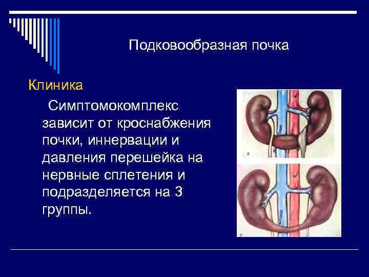 Клинику почки. Подковообразная аномалия почки. Аномалия развития почек подковообразная почка. Подковообразная почка клинические рекомендации. ВПР МВС подковообразная почка.