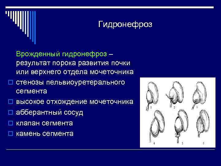 Аномалии развития почки картинки