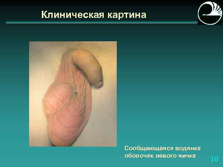 Клиническая картина Сообщающаяся водянка оболочек левого яичка 10 