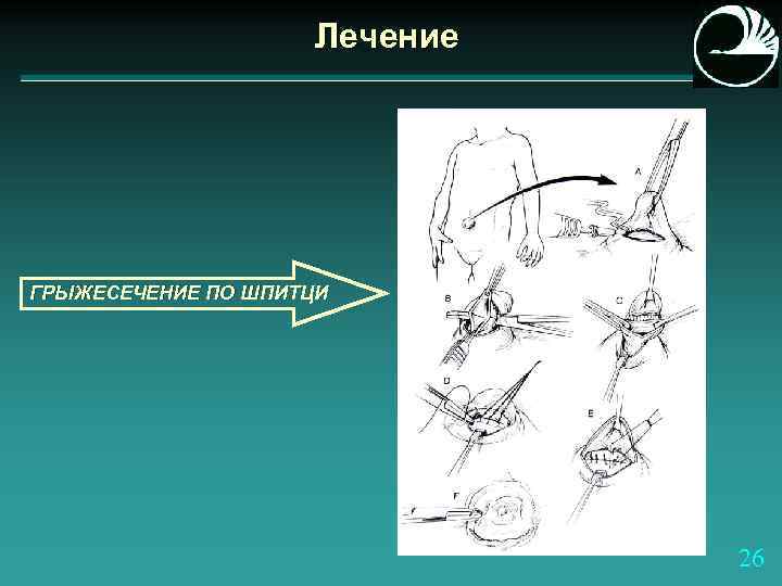 Лечение ГРЫЖЕСЕЧЕНИЕ ПО ШПИТЦИ 26 
