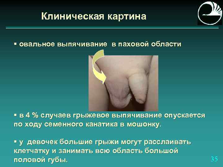 Клиническая картина § овальное выпячивание в паховой области § в 4 % случаев грыжевое