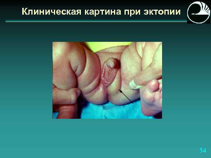 Клиническая картина при эктопии 54 