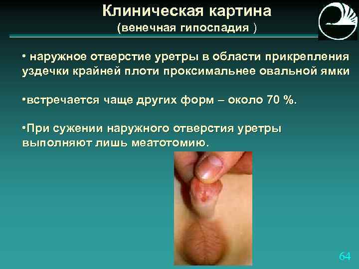 Клиническая картина (венечная гипоспадия ) • наружное отверстие уретры в области прикрепления уздечки крайней