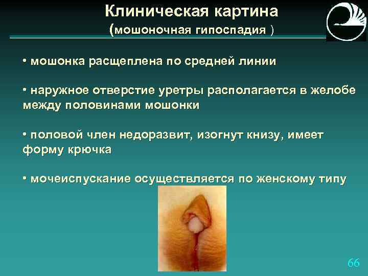 Клиническая картина (мошоночная гипоспадия ) • мошонка расщеплена по средней линии • наружное отверстие