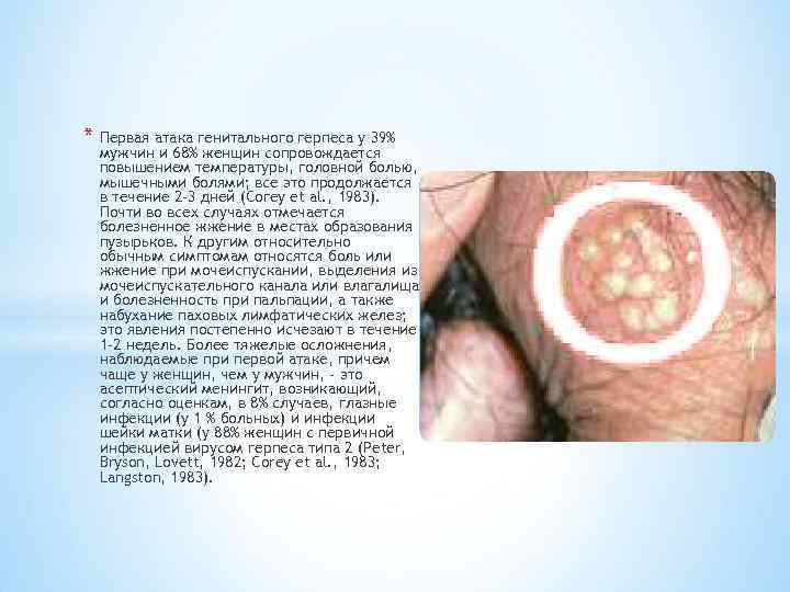 * Первая атака генитального герпеса у 39% мужчин и 68% женщин сопровождается повышением температуры,