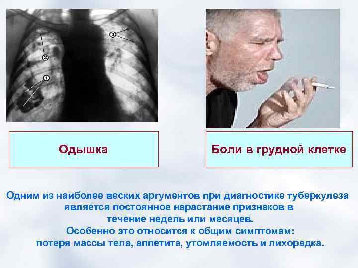 Одышка Боли в грудной клетке Одним из наиболее веских аргументов при диагностике туберкулеза является