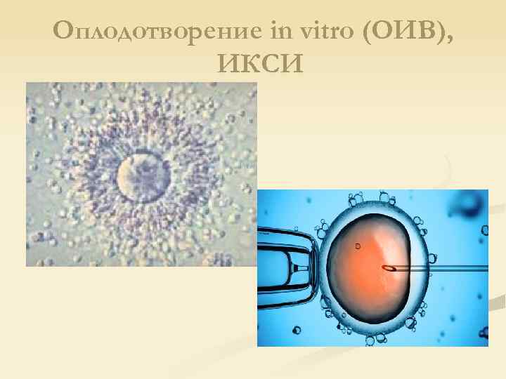 Оплодотворение in vitro (ОИВ), ИКСИ 