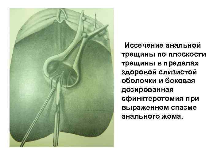 Иссечение анальной трещины по плоскости трещины в пределах здоровой слизистой оболочки и боковая дозированная