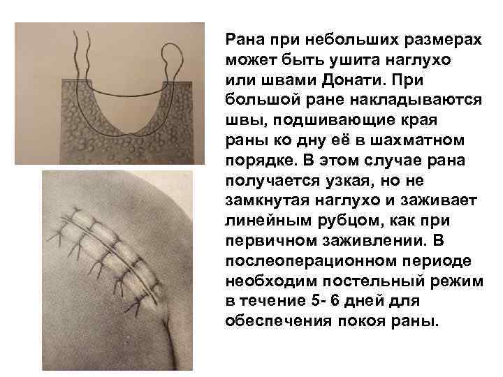 Рана при небольших размерах может быть ушита наглухо или швами Донати. При большой ране