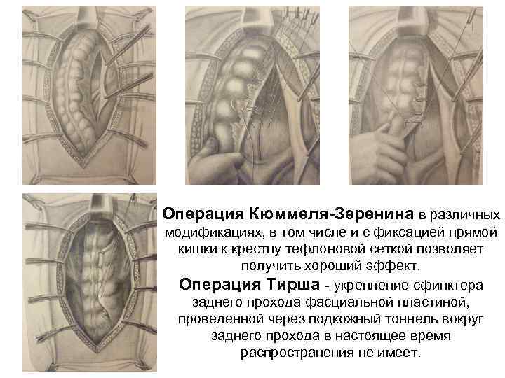 Заболевания прямой кишки презентация