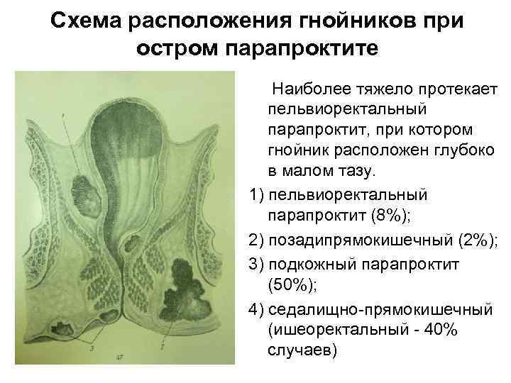 Схема расположения гнойников при остром парапроктите Наиболее тяжело протекает пельвиоректальный парапроктит, при котором гнойник