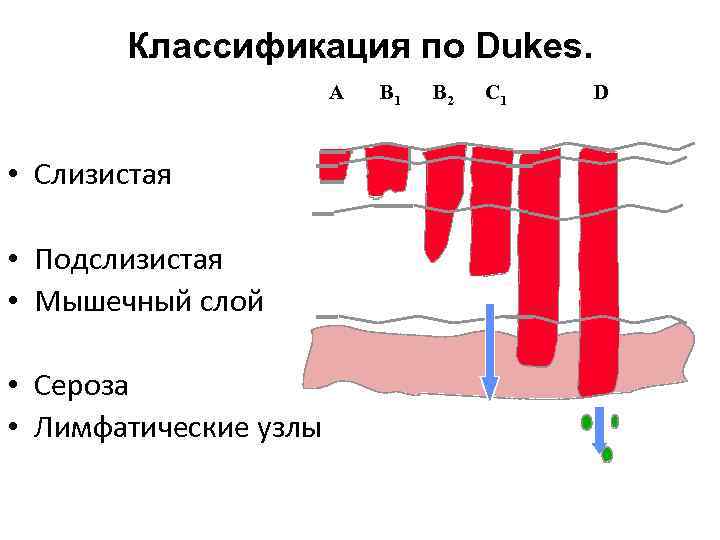 Классификация по Dukes. A • Слизистая • Подслизистая • Мышечный слой • Сероза •