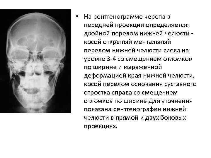  • На рентгенограмме черепа в передней проекции определяется: двойной перелом нижней челюсти косой